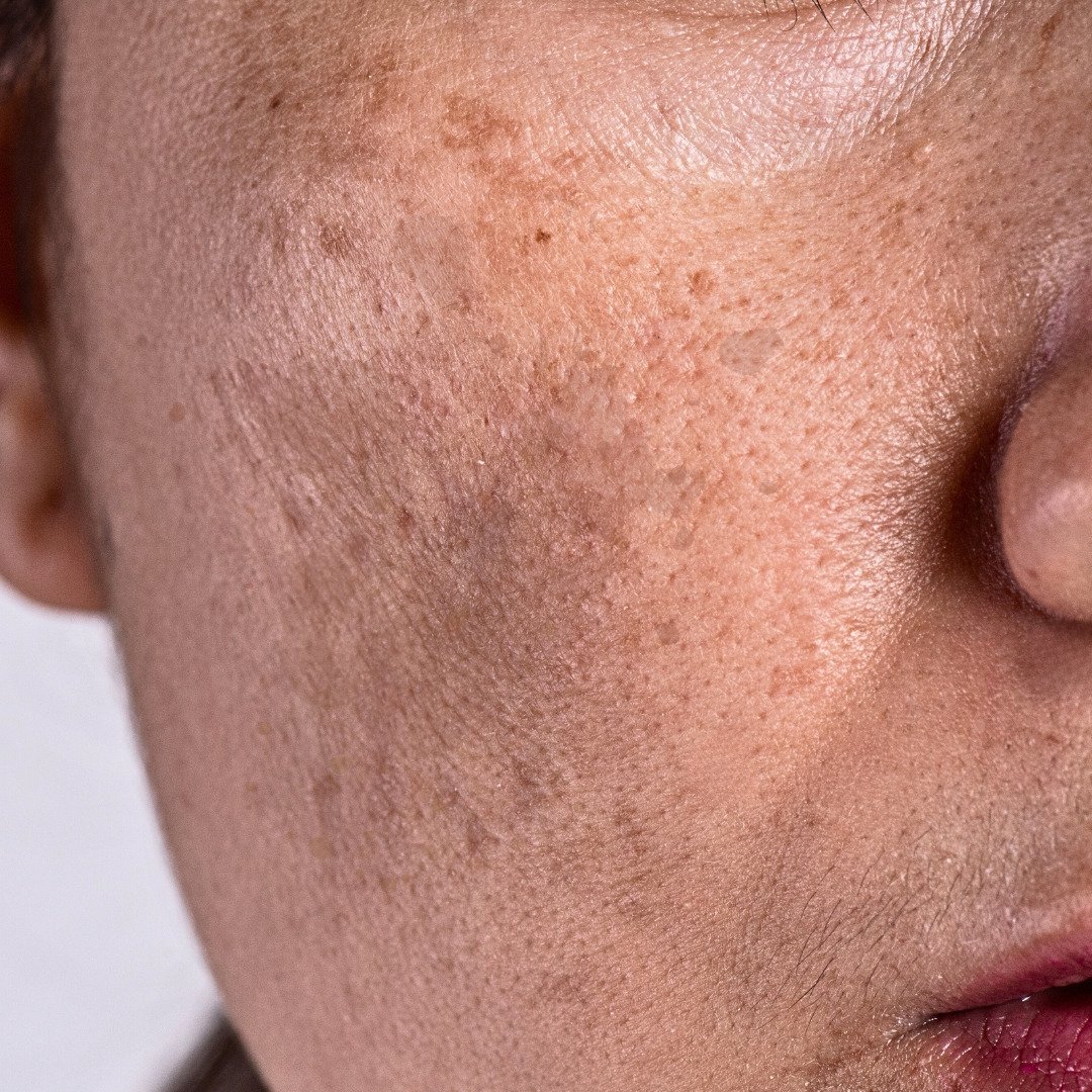 Pigmentation